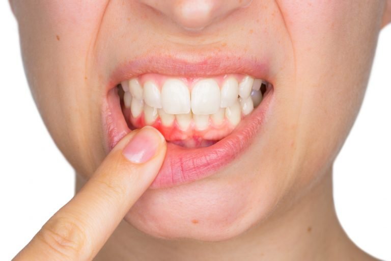 Gingivitis and Periodontitis: Gum Disease