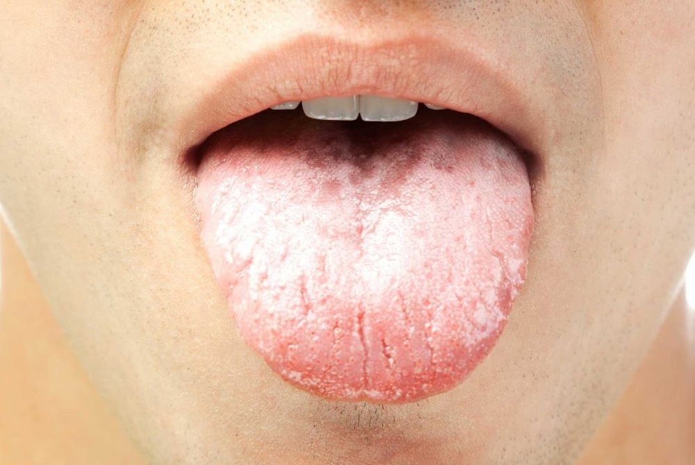 Thrush (oral candidiasis) or oral thrush is a fungal infection (overgrowth ...