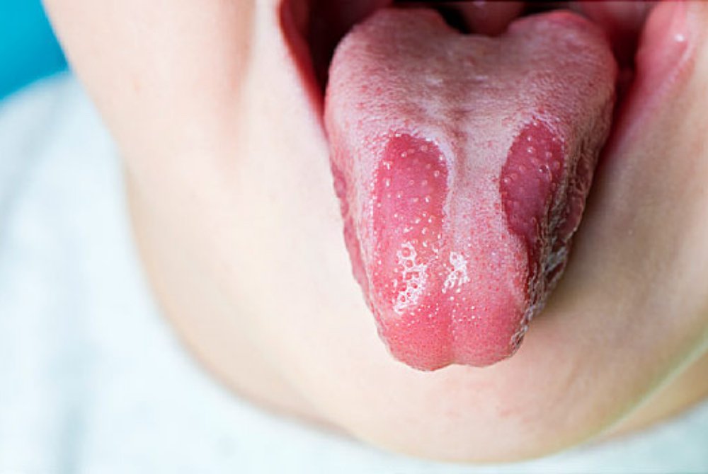 14+ Geographic Tongue Pregnancy Symptom